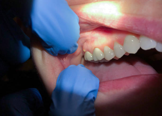 Best Cracked Tooth Emergency Dentist  in Cynthiana, KY